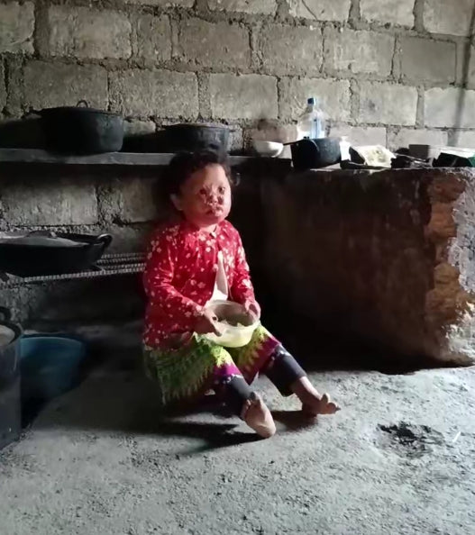 كاب باخ! Giúp đỡ trẻ bị bỏng sâu