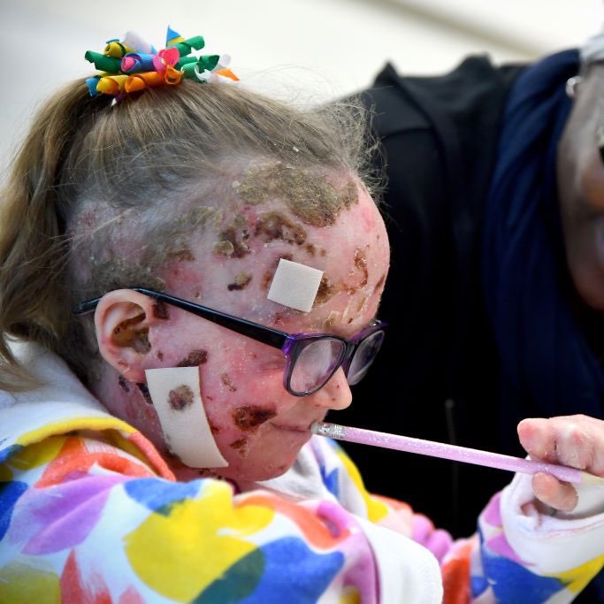 Epidermolysis Bullosa Charity, suas doações salvam vidas