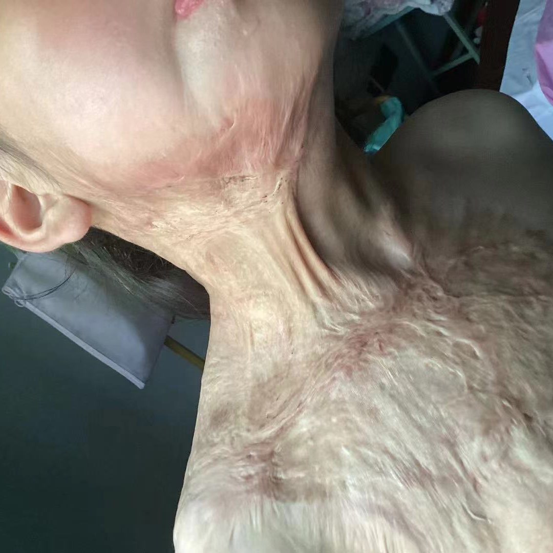 عاجل! مساعدة الأطفال المصابين بحروق عميقة